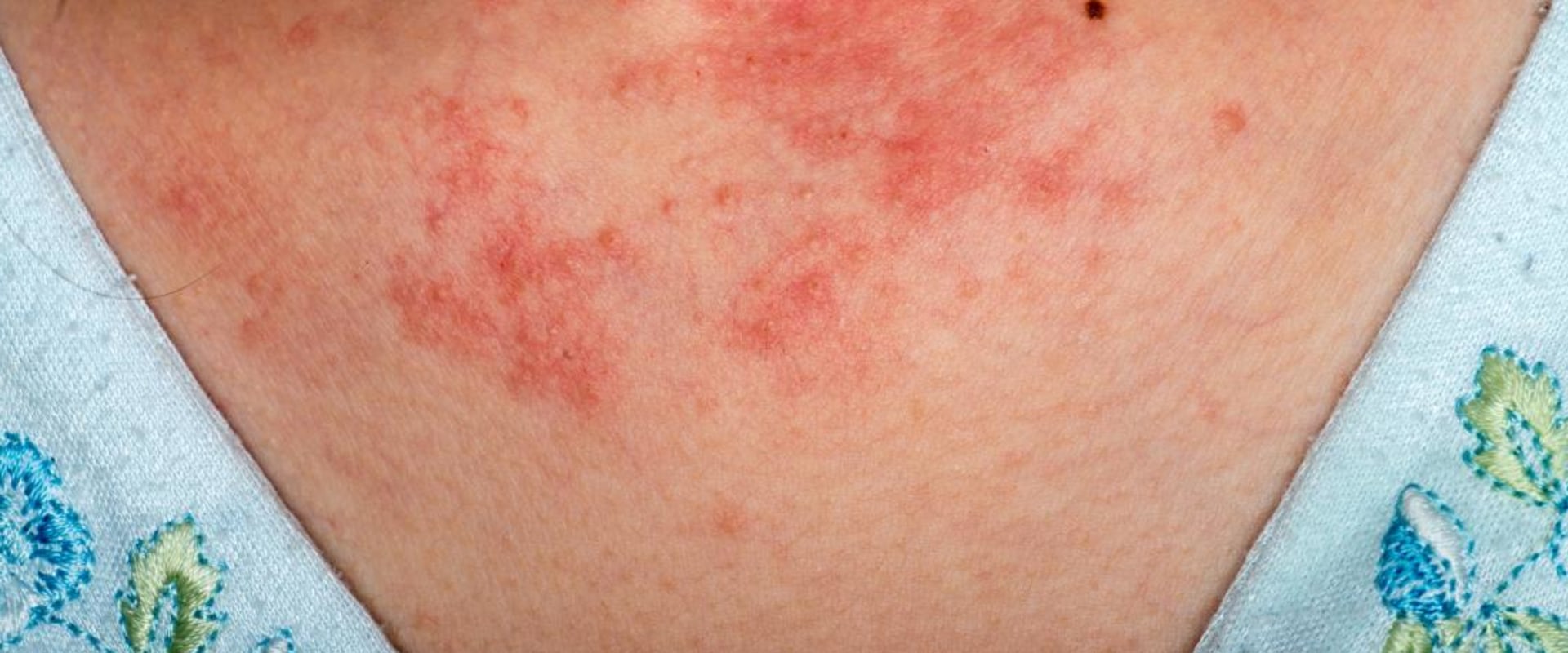 what-are-the-causes-of-sudden-eczema-outbreaks